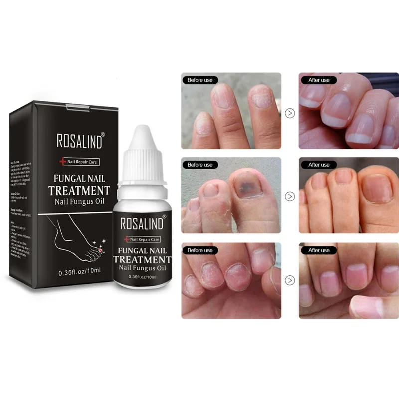 Kills 99.9% Bacteria Nail Care Treatment Nail Fungus Oil Onychomycosis Paronychia Anti Fungal Nail Infection 10ml Repair Nails
Kills 99.9% Bacteria Nail Care Treatment Nail Fungus Oil Onychomycosis Paronychia Anti Fungal Nail Infection 10ml Repair Nails