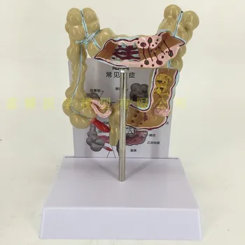 Colonic pathology large intestine olorectal lesion model intestinal disease colonic lesion
Colonic pathology large intestine olorectal lesion model intestinal disease colonic lesion