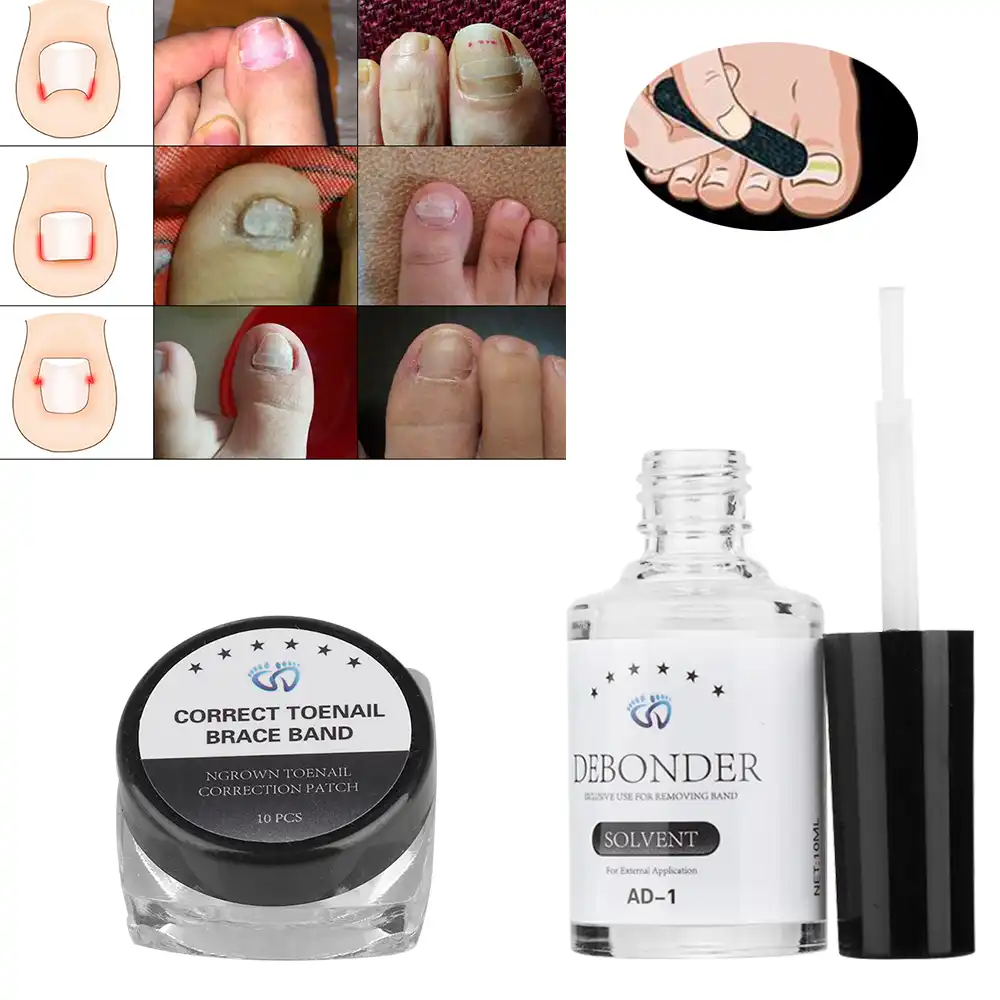 foot care ingrown toenail correction set nail pedicure