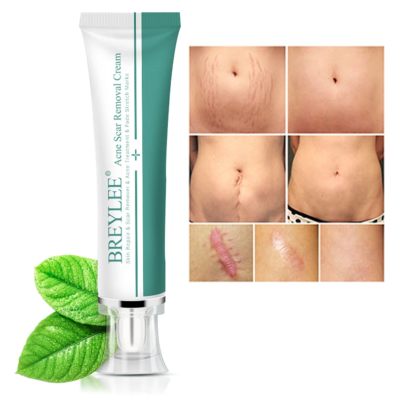 BREYLEE Removal Scar Cream Face Pimples Scar Stretch Marks Removal Acne Treatment Whitening Moisturizing Cream Skin Care
BREYLEE Removal Scar Cream Face Pimples Scar Stretch Marks Removal Acne Treatment Whitening Moisturizing Cream Skin Care