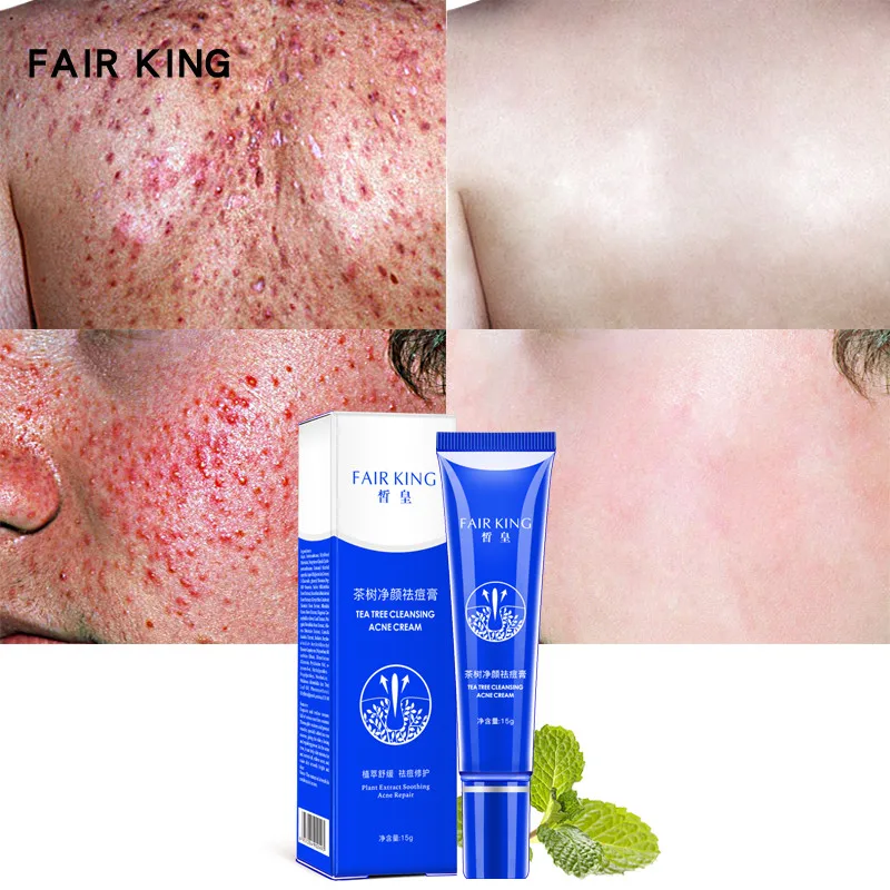 Face Care Tools Tea Tree Cleansing Acne Cream Face Anti Acne Treatment Cream Moisturize Control Oil Skin Care Face Acne Repair
Face Care Tools Tea Tree Cleansing Acne Cream Face Anti Acne Treatment Cream Moisturize Control Oil Skin Care Face Acne Repair