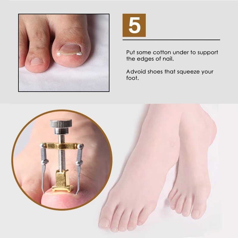 Nail-Corrector--08