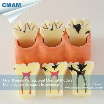 DH/13141, Tooth Caries Anatomy, 4Times Bigger Caries Disassembling Model, Educational Teaching Anatomical Models
DH/13141, Tooth Caries Anatomy, 4Times Bigger Caries Disassembling Model, Educational Teaching Anatomical Models