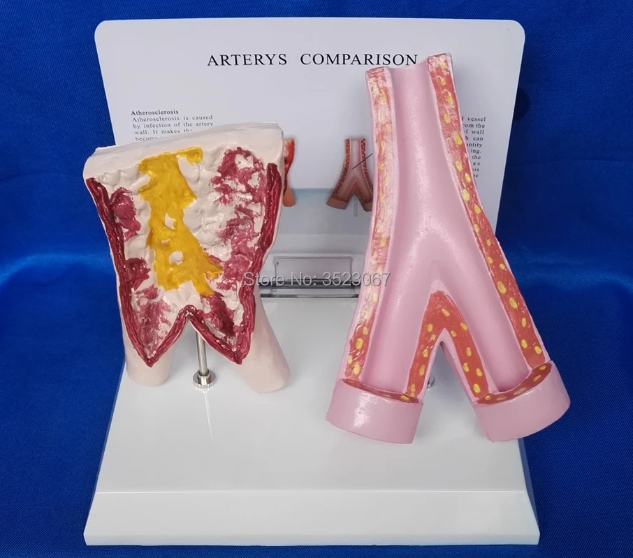 life size Human disease Atherosclerosis comparison Model arterys comparison Teach Anatomy Nurse Training Study syringe Display
life size Human disease Atherosclerosis comparison Model arterys comparison Teach Anatomy Nurse Training Study syringe Display