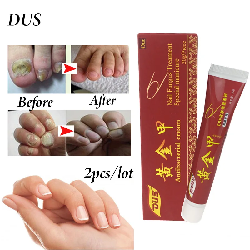 Nail Fungus Treatment Onychomycosis Paronychia Anti Fungal Nail Infection Good Result Chinese Herbal Toe Nail Treatment
Nail Fungus Treatment Onychomycosis Paronychia Anti Fungal Nail Infection Good Result Chinese Herbal Toe Nail Treatment