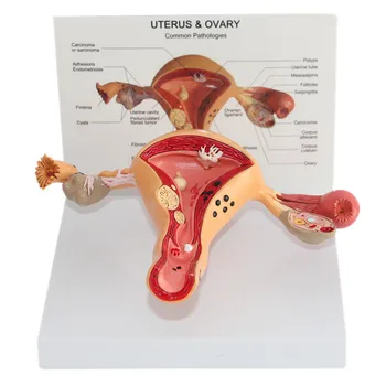Uterine lesion model ovarian uterine pathology female genital anatomy model
Uterine lesion model ovarian uterine pathology female genital anatomy model