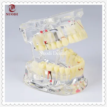 Dental Implant Bridge Model/Education teeth model/Removable implant crown &abutment/Transparent Adult Pathological Teeth Model
Dental Implant Bridge Model/Education teeth model/Removable implant crown &abutment/Transparent Adult Pathological Teeth Model