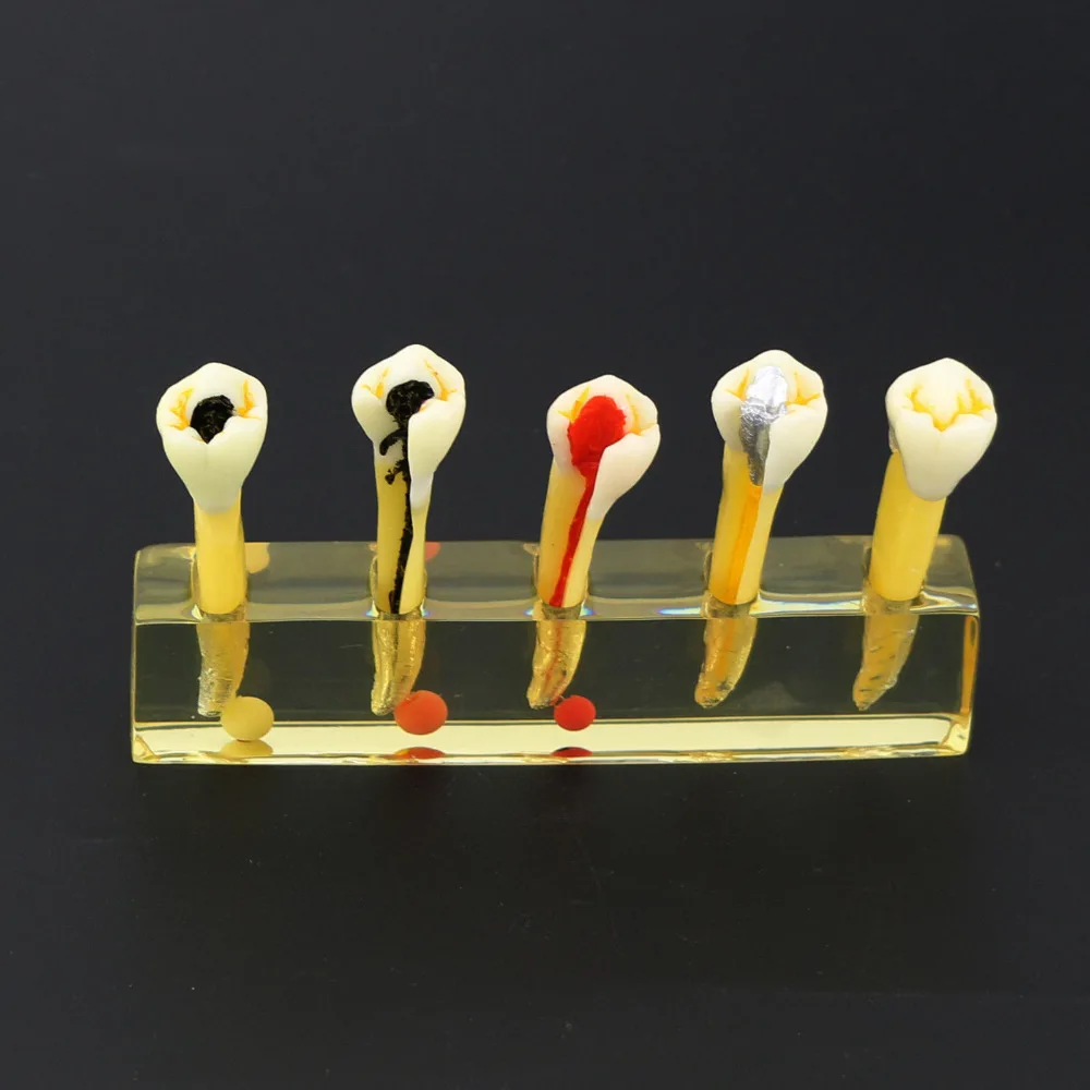 Dental 5 Stage Root Canal Endodontic Treatment Model Dental Study Teach Teeth Model
Dental 5 Stage Root Canal Endodontic Treatment Model Dental Study Teach Teeth Model