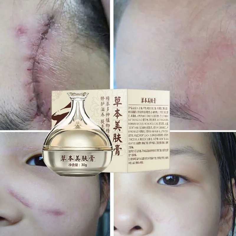 Chinese Medicine Strong Facial Care Scar Treatment Surgery Burn Repair Scald Acne Cream Skin Care
Chinese Medicine Strong Facial Care Scar Treatment Surgery Burn Repair Scald Acne Cream Skin Care