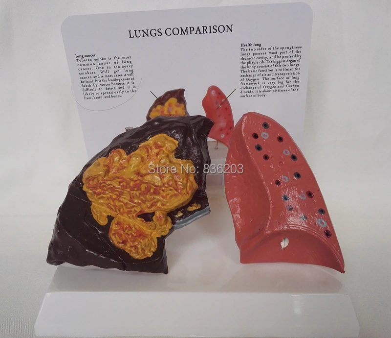 life size Human disease lungs comparison Model Teach Disease of the lung cancer Anatomy Nurse Training Study syringe Display
life size Human disease lungs comparison Model Teach Disease of the lung cancer Anatomy Nurse Training Study syringe Display