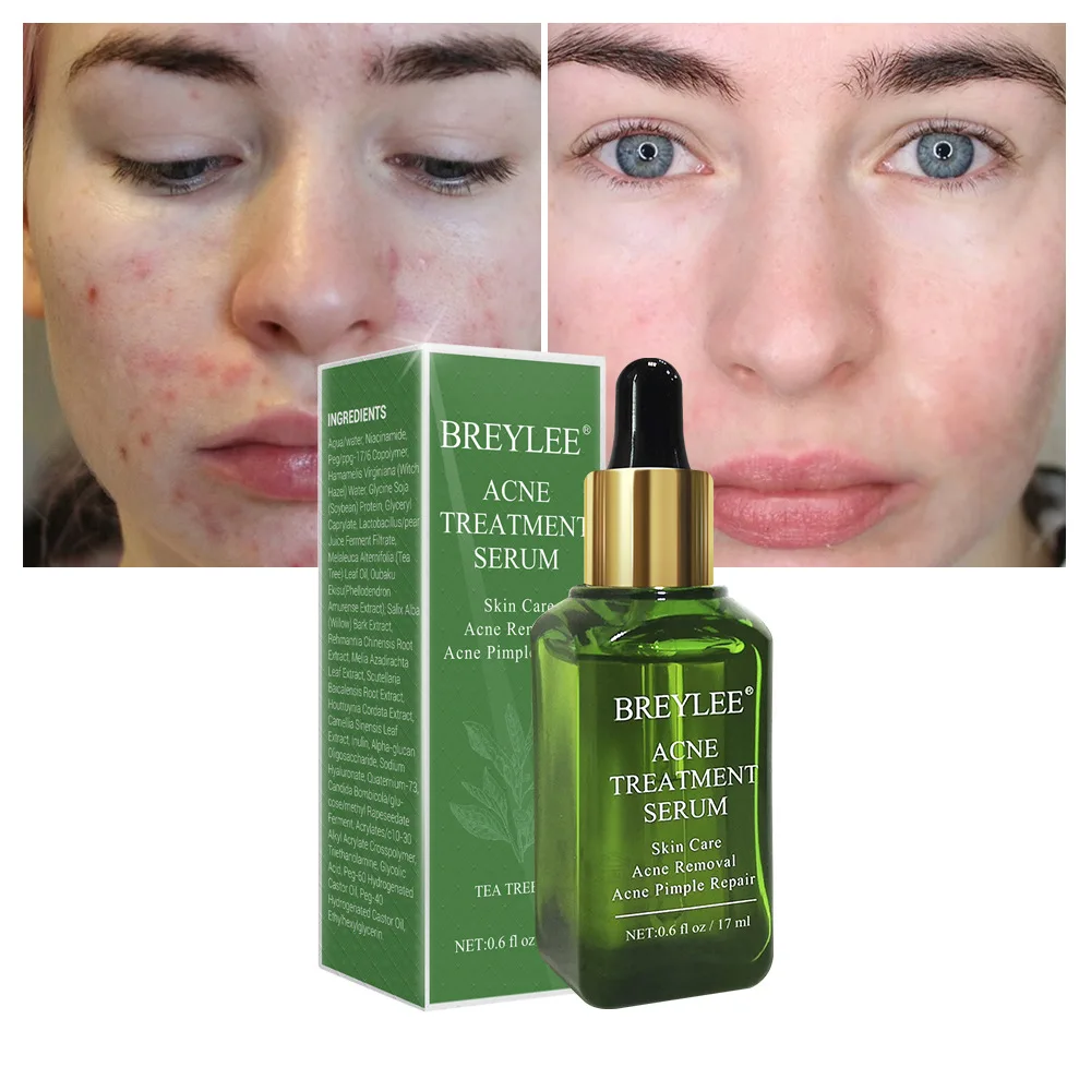 Acne Treatment Serum Face Facial Essence Anti Acne Scar Blackhead Removal Cream Skin Care Dental Whitener Repair Pimple Remover
Acne Treatment Serum Face Facial Essence Anti Acne Scar Blackhead Removal Cream Skin Care Dental Whitener Repair Pimple Remover