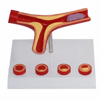 Human Vascular Model arterial atherosclerosis model Cardiovascular Arteriosclerosis Model Thrombosis model
Human Vascular Model arterial atherosclerosis model Cardiovascular Arteriosclerosis Model Thrombosis model