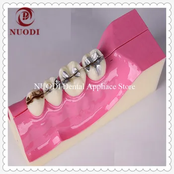 Molar cross section study model/Dental molar teeth model Showing impaction/Molar cross section Education Teeth model
Molar cross section study model/Dental molar teeth model Showing impaction/Molar cross section Education Teeth model