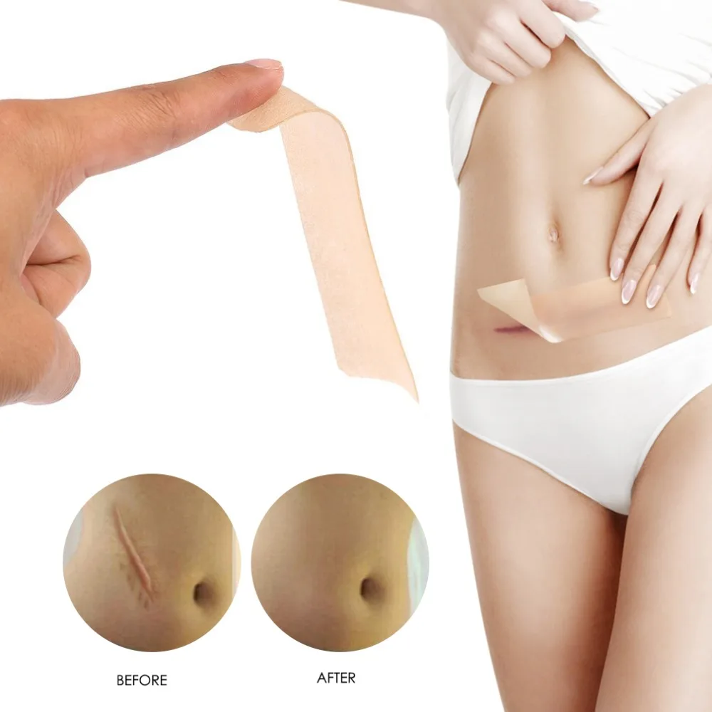 HOT 3.5x15cm Efficient Surgery Scar Removal Silicone Gel Sheet Therapy Patch for Acne Trauma Burn Scar Skin Repair Scar
HOT 3.5x15cm Efficient Surgery Scar Removal Silicone Gel Sheet Therapy Patch for Acne Trauma Burn Scar Skin Repair Scar