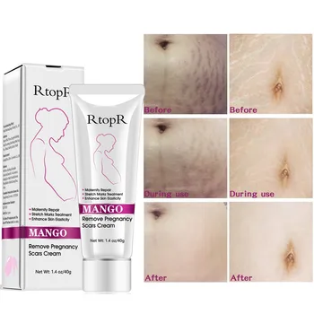 Acne Cream Stretch Marks Treatment Maternity Repair Anti-Aging Anti Winkles Firming Body Creams Remove Pregnancy Scars
Acne Cream Stretch Marks Treatment Maternity Repair Anti-Aging Anti Winkles Firming Body Creams Remove Pregnancy Scars