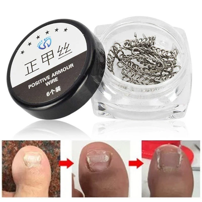 Sale 12pcs/Set Nail Correction Foot Care Tool Wire Fixer Pedicure Toenails Corrector Paronychia Recover Ingrown Toe
Sale 12pcs/Set Nail Correction Foot Care Tool Wire Fixer Pedicure Toenails Corrector Paronychia Recover Ingrown Toe