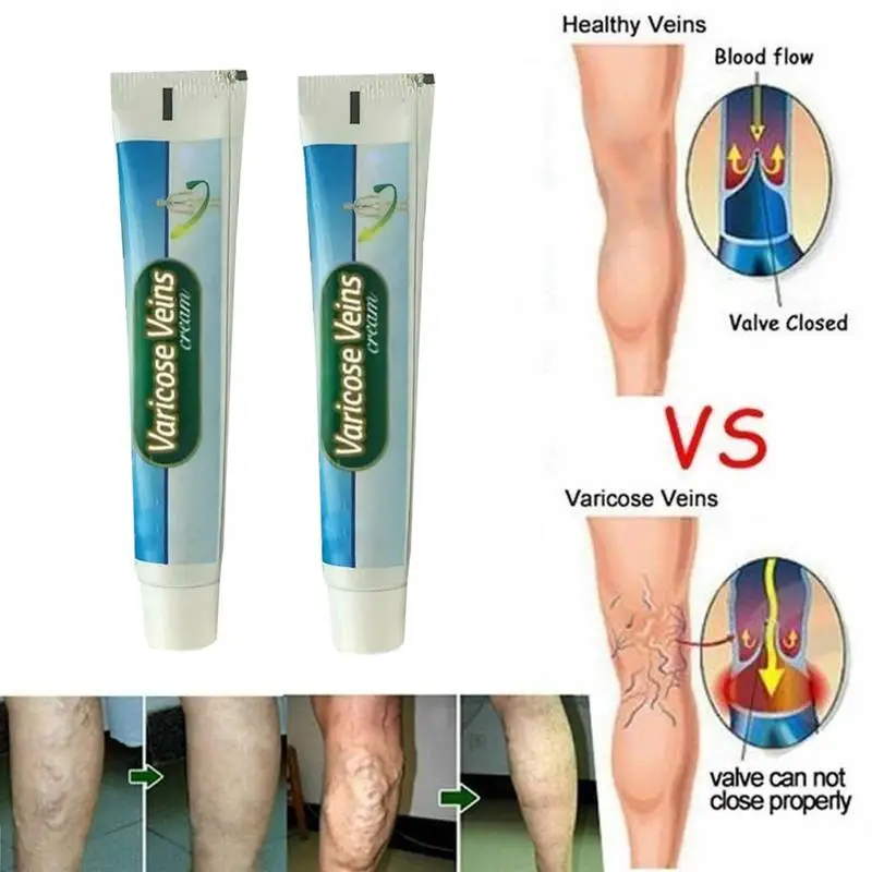 Varicose Veins Ointment Vasculitis Treatment Phlebitis Angiitis Inflammation Blood Vessel Rotten Legs Spider Treatment Cream
Varicose Veins Ointment Vasculitis Treatment Phlebitis Angiitis Inflammation Blood Vessel Rotten Legs Spider Treatment Cream