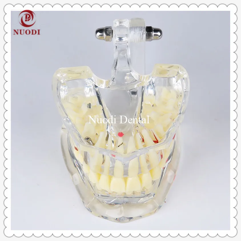 Dental Implant Bridge Model Removeable bridge crown/Education teeth model/Removable implant crown and abutment
Dental Implant Bridge Model Removeable bridge crown/Education teeth model/Removable implant crown and abutment
