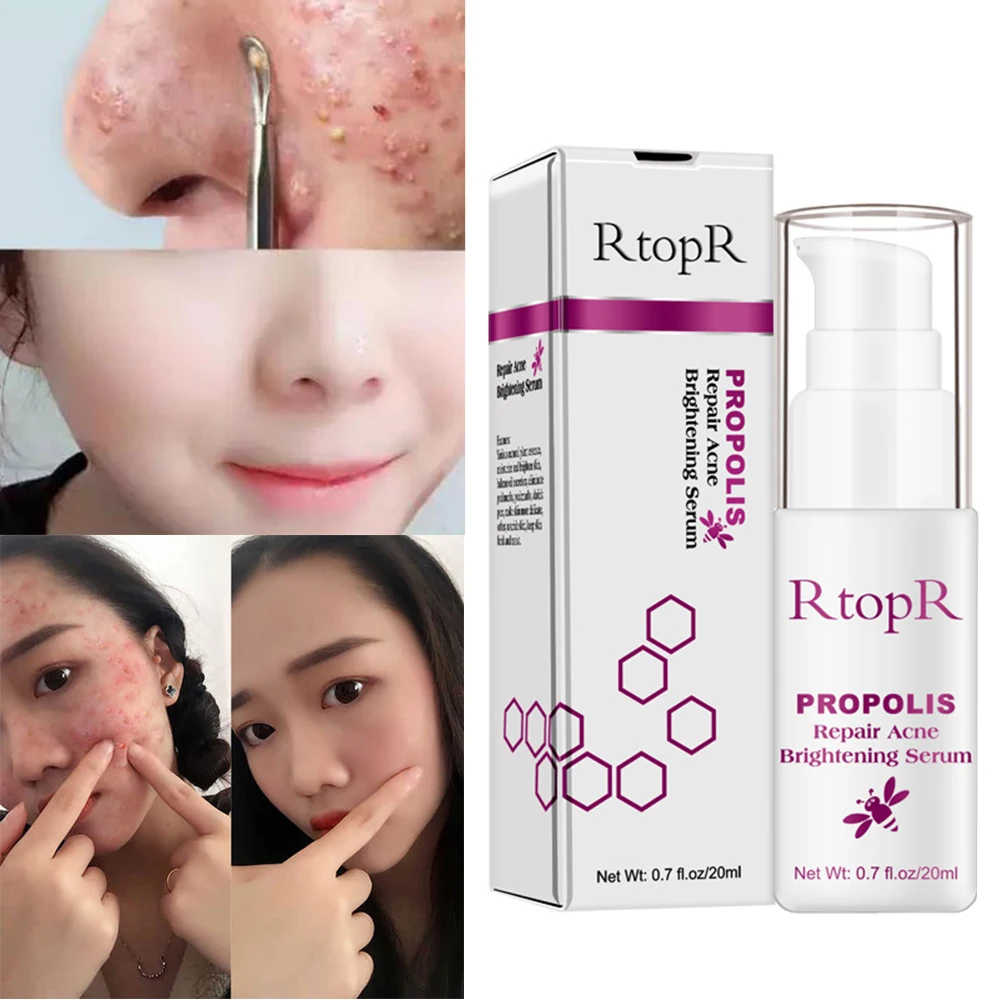 RtopR 20ml Vitamin C Propolis Facial Brightening Essence Shrink Pores Serum Acne Scar Face Cream Eliminate Freckle TSLM2
RtopR 20ml Vitamin C Propolis Facial Brightening Essence Shrink Pores Serum Acne Scar Face Cream Eliminate Freckle TSLM2