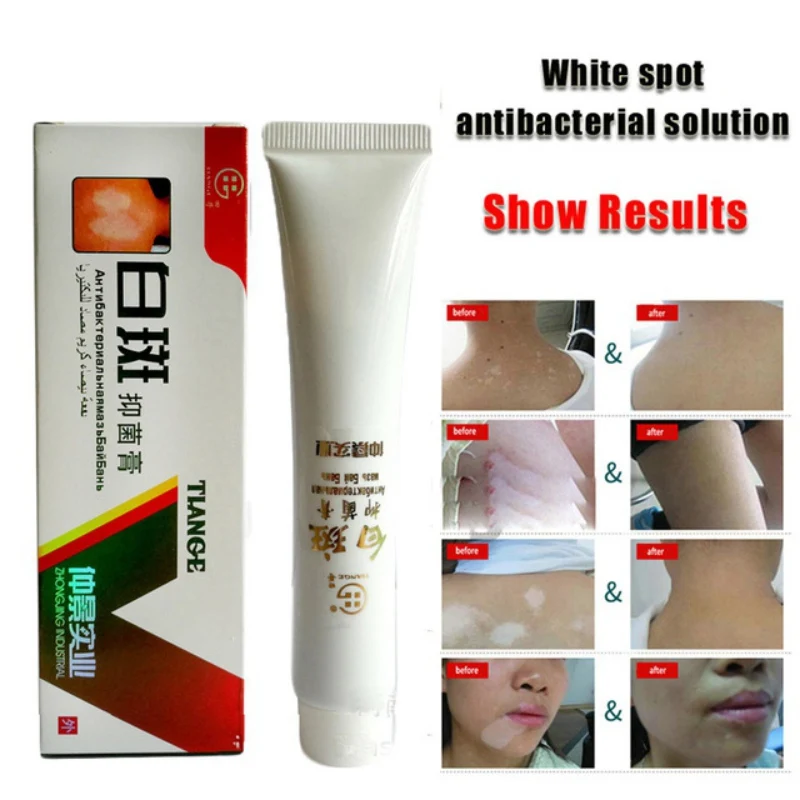 Chinese Medical White Spot Disease Cream Pigment Melanin Promoting Liniment Skin Vitiligo Leukoplakia Disease Treatment 30gS1
Chinese Medical White Spot Disease Cream Pigment Melanin Promoting Liniment Skin Vitiligo Leukoplakia Disease Treatment 30gS1