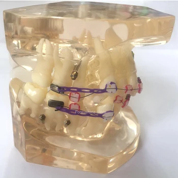 Semi-ceramic semi-metal orthodontic model dental tooth models brackets tooth irregular, gagtooth bucktooth,agomphassis brackets
Semi-ceramic semi-metal orthodontic model dental tooth models brackets tooth irregular, gagtooth bucktooth,agomphassis brackets