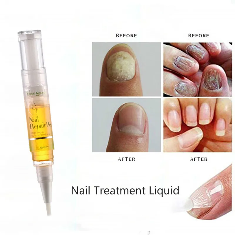 1 PCS Nail Treatment Pen Onychomycosis Paronychia Anti Fungal Nail Infection 5ml Chinese Herbal Care Medicinal Liquid TSLM1
1 PCS Nail Treatment Pen Onychomycosis Paronychia Anti Fungal Nail Infection 5ml Chinese Herbal Care Medicinal Liquid TSLM1