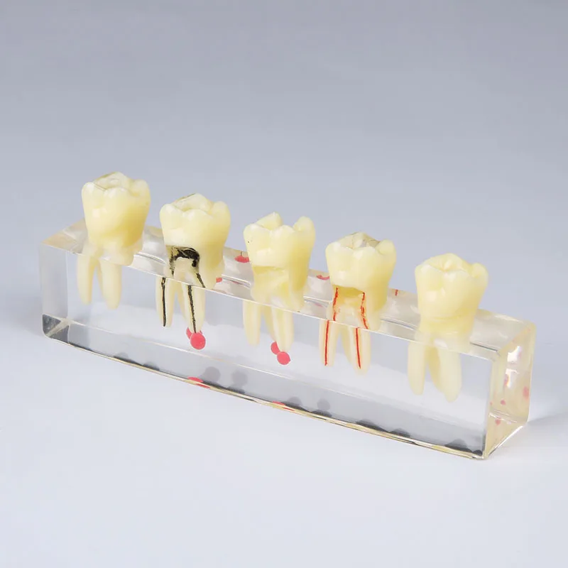 1 Pc Dental Oral Endo Root Canal Treatment Teeth Model For Teaching Communication M-4012
1 Pc Dental Oral Endo Root Canal Treatment Teeth Model For Teaching Communication M-4012