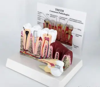 Teeth common pathologies model oral model detachable tooth anatomical dental teaching model
Teeth common pathologies model oral model detachable tooth anatomical dental teaching model