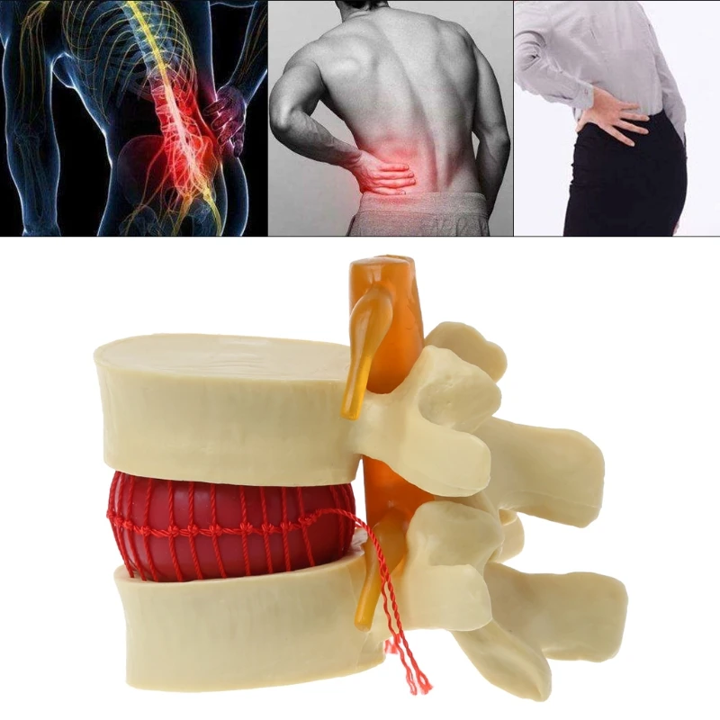 Lumbar Vertebrae Model Anatomical Spine Lumbar Disc Herniation Anatomy Medical Teaching Tool Lumbar Vertebrae Model
Lumbar Vertebrae Model Anatomical Spine Lumbar Disc Herniation Anatomy Medical Teaching Tool Lumbar Vertebrae Model