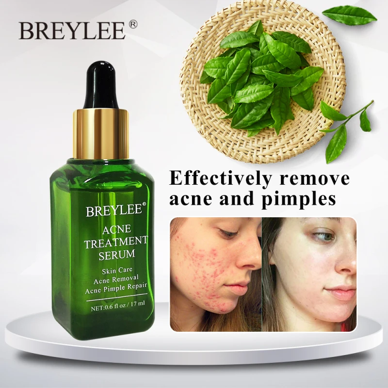 green tea anti acne essence cream
