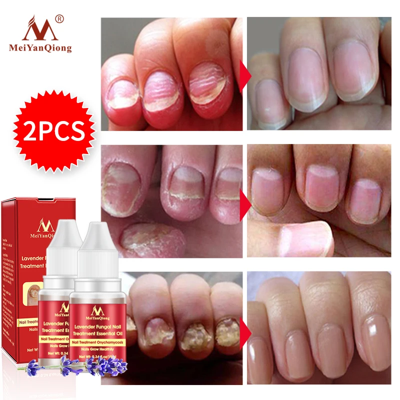 Nail Repair Essence Serum Fungal Nail Treatment Remove Onychomycosis Toe Nail Nourishing Brightening Hand And Foot Care Essence
Nail Repair Essence Serum Fungal Nail Treatment Remove Onychomycosis Toe Nail Nourishing Brightening Hand And Foot Care Essence