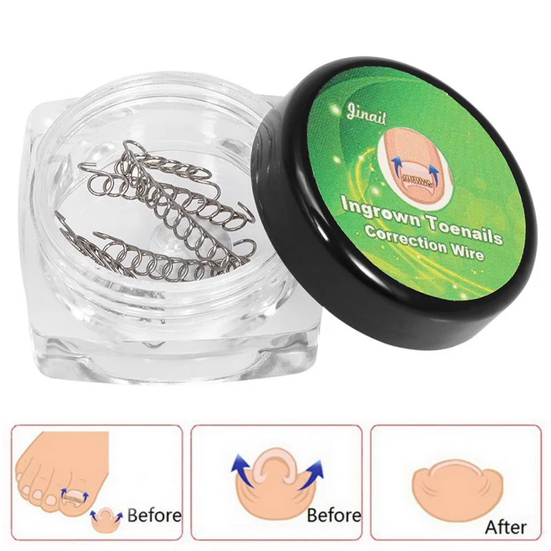 6 pcs Toenails Corrector Ingrown Toe Nail Correction Wire Pedicure Paronychia Recover Foot Care Tool Pedicure Tools
6 pcs Toenails Corrector Ingrown Toe Nail Correction Wire Pedicure Paronychia Recover Foot Care Tool Pedicure Tools
