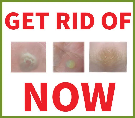 BEST Over The Counter TREAMENT for WART Remover , SKIN TAG Remover FAST RESULT!!
BEST Over The Counter TREAMENT for WART Remover , SKIN TAG Remover FAST RESULT!!