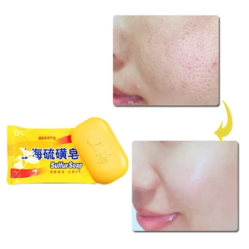 Shanghai sulfur soap oil-control acne treatment blackhead remover soap 85g Whitening cleanser Chinese traditional Skin care
Shanghai sulfur soap oil-control acne treatment blackhead remover soap 85g Whitening cleanser Chinese traditional Skin care