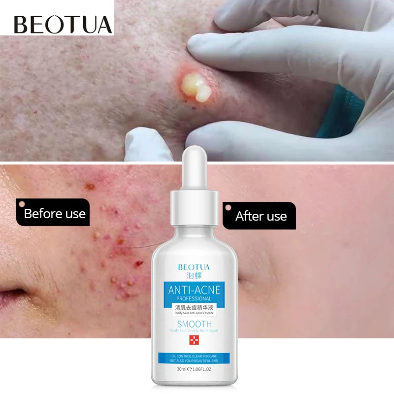 BEOTUA Rejuvenation Acne Serum Anti Acne Treatment Scar Removal Gel Whitening Moisturizing Shrink Pores Beauty Face Skin Care
BEOTUA Rejuvenation Acne Serum Anti Acne Treatment Scar Removal Gel Whitening Moisturizing Shrink Pores Beauty Face Skin Care