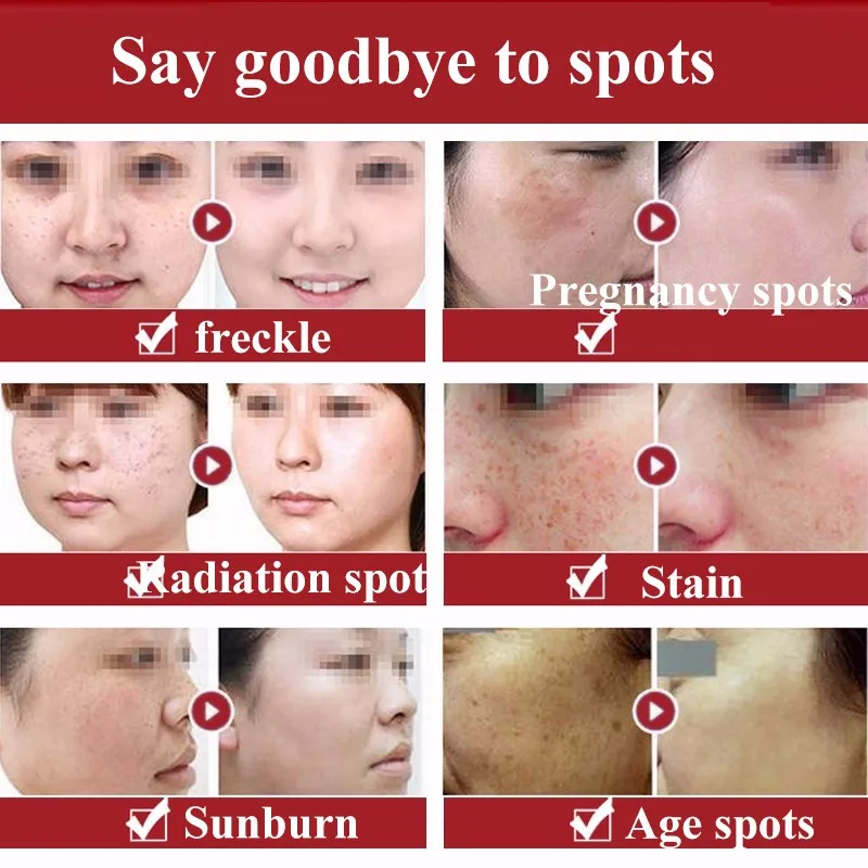 APINKGIRL-Whitening-Freckle-Cream-Remove-Melasma-Anti-Dark-Spot-Remover-Acne-Pigment-Melanin-Speckle-Blemish-Face (4)
