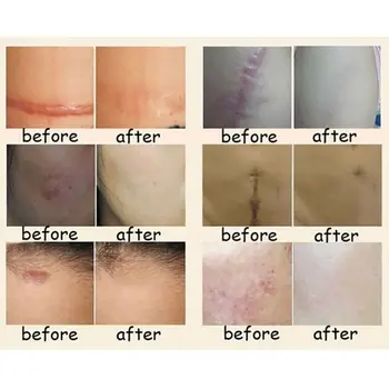 Nuobisong Facial Scar Removal Cremas Facial Treatment Whitening Face Cream Stretch Marks Moisturizing
Nuobisong Facial Scar Removal Cremas Facial Treatment Whitening Face Cream Stretch Marks Moisturizing