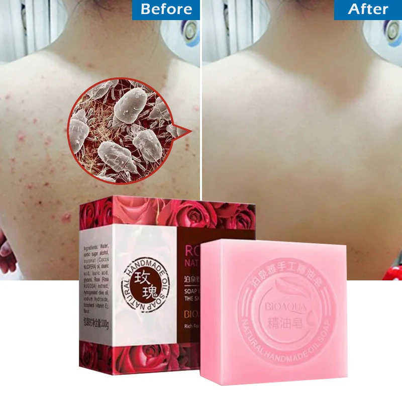 Soap Roses Whitening Base Skin Bleaching Kojic Acid Handmade Lightening Pimple Acne Treatment Face Clean Bath Body Wash Savon L
Soap Roses Whitening Base Skin Bleaching Kojic Acid Handmade Lightening Pimple Acne Treatment Face Clean Bath Body Wash Savon L