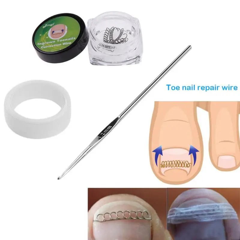 8pcs/set Ingrown Toe Nail Correction Wire Fixer Pedicure Recover Paronychia Acronyx Onyxis Bunion Corrector Foot Care Tool
8pcs/set Ingrown Toe Nail Correction Wire Fixer Pedicure Recover Paronychia Acronyx Onyxis Bunion Corrector Foot Care Tool