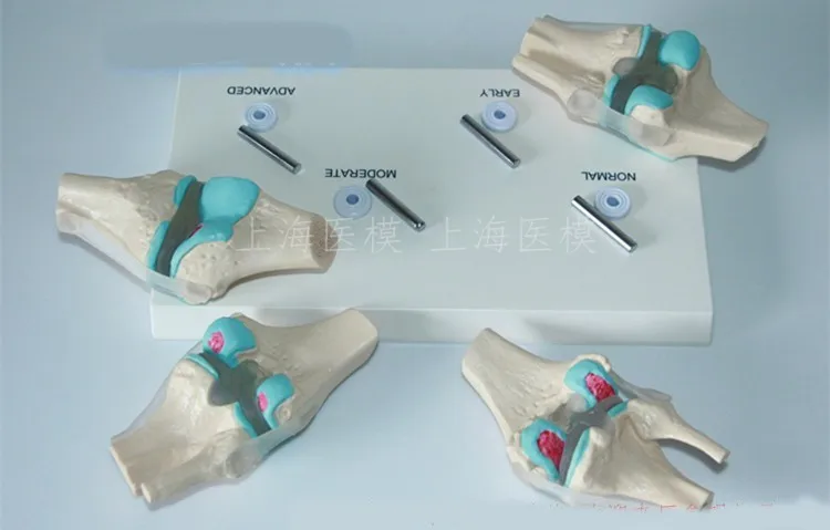 skeleton model human knee osteoarthritis disease knee joint knee Lesions arthritis model free shipping
skeleton model human knee osteoarthritis disease knee joint knee Lesions arthritis model free shipping