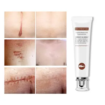 Acne Scar Removal Cream Skin Repair Face Cream Acne Spots Acne Treatment Whitening Cream Anti Scar Stretch Marks 20g
Acne Scar Removal Cream Skin Repair Face Cream Acne Spots Acne Treatment Whitening Cream Anti Scar Stretch Marks 20g