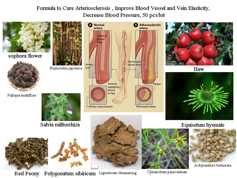 Formula of All Natural Herbal Ingredients to Cure Arteriosclerosis, Increase Artery Elasticity, Cleanse Blood Vessels and Veins
Formula of All Natural Herbal Ingredients to Cure Arteriosclerosis, Increase Artery Elasticity, Cleanse Blood Vessels and Veins