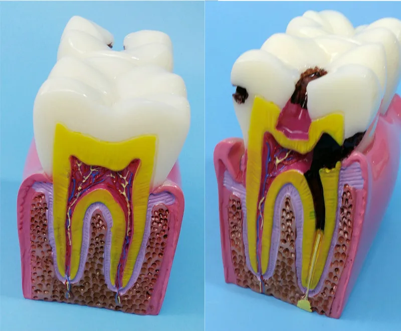 Oral 6X Enlarge Human Teeth Model Human Teeth Anatomy Model Human Caries Model Medical Teaching Aids Dentist Teaching Equipment
Oral 6X Enlarge Human Teeth Model Human Teeth Anatomy Model Human Caries Model Medical Teaching Aids Dentist Teaching Equipment