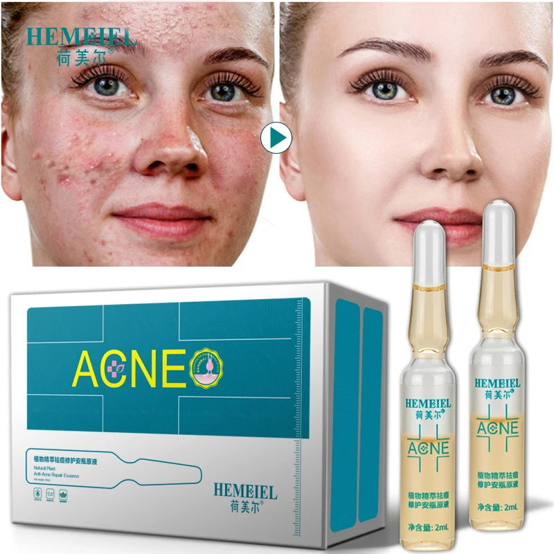 HEMEIEL Anti-Acne Serum Scar Removal Natural Essence Pimple Acne Treatment Repair Scars Facial Whitening Oil Control Skin Care
HEMEIEL Anti-Acne Serum Scar Removal Natural Essence Pimple Acne Treatment Repair Scars Facial Whitening Oil Control Skin Care