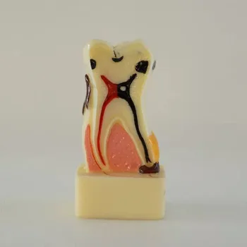 4 Times periodontal disease model pathology tooth model
4 Times periodontal disease model pathology tooth model