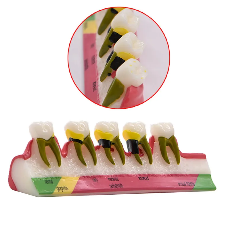 2018 New Arrival Dental caries classification model Developing illusteation Tooth Model Demonstration Teach Model Patient
2018 New Arrival Dental caries classification model Developing illusteation Tooth Model Demonstration Teach Model Patient