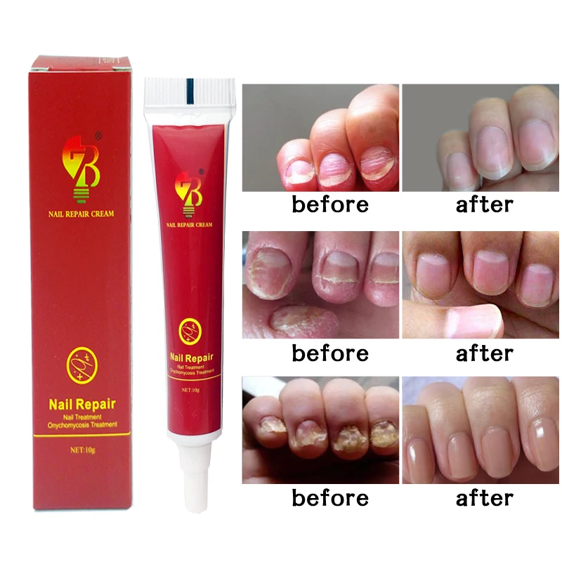 Chinese Medicine Plaster Nail Treatment Cream Onychomycosis Anti Nail Infection Fights Bacteria Naturally ointment
Chinese Medicine Plaster Nail Treatment Cream Onychomycosis Anti Nail Infection Fights Bacteria Naturally ointment