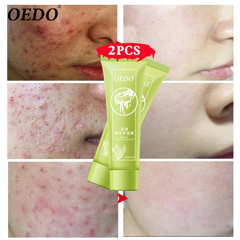 2pcs/lot OEDO Seaweed Aloe Vera Gel Moisturizing Whitening Anti-Acne Anti-Aging Anti-Wrinkle Collagen Cream Brightens Skin Tone
2pcs/lot OEDO Seaweed Aloe Vera Gel Moisturizing Whitening Anti-Acne Anti-Aging Anti-Wrinkle Collagen Cream Brightens Skin Tone
