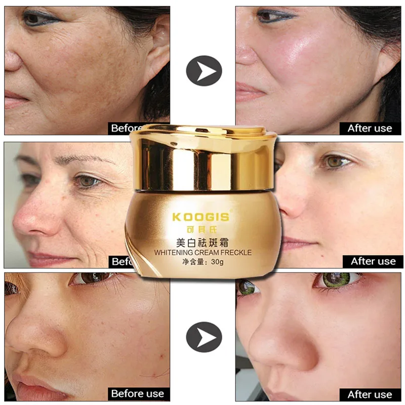 Whitening Cream Melasma Pigmentation Removal Dark Spot Remover For Face Care Lightening Cream Crema Blanqueadora
Whitening Cream Melasma Pigmentation Removal Dark Spot Remover For Face Care Lightening Cream Crema Blanqueadora
