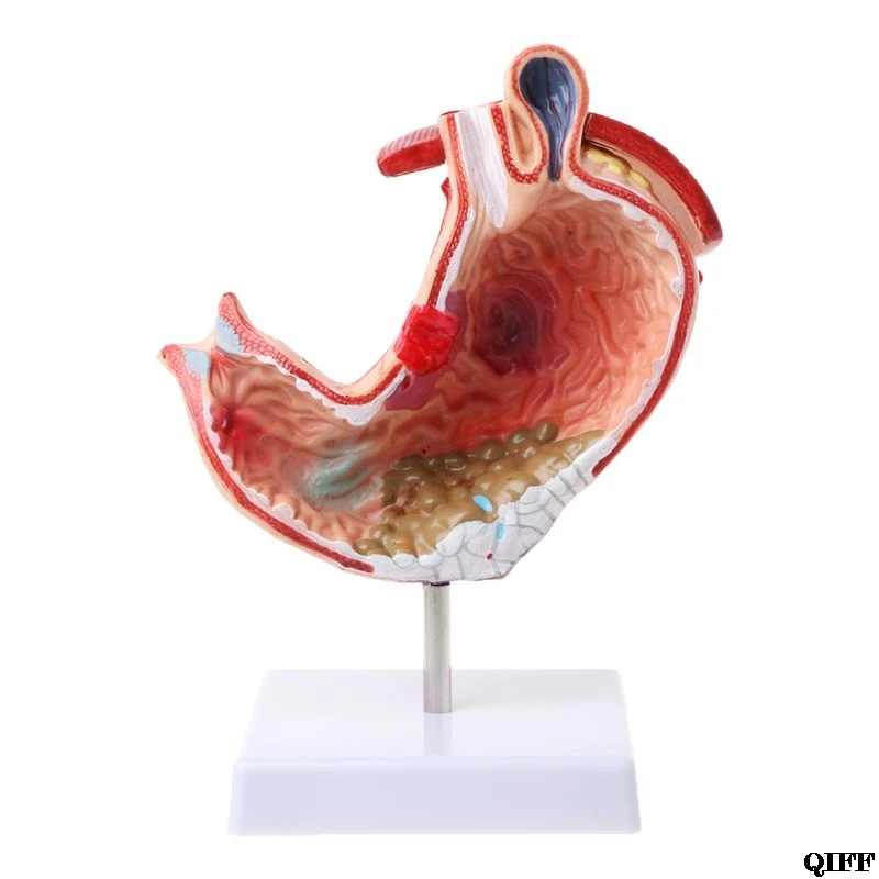Human Anatomical Anatomy Stomach Medical Model Gastric Pathology Gastritis Ulcer Medical Teaching Learning Tool July 10
Human Anatomical Anatomy Stomach Medical Model Gastric Pathology Gastritis Ulcer Medical Teaching Learning Tool July 10